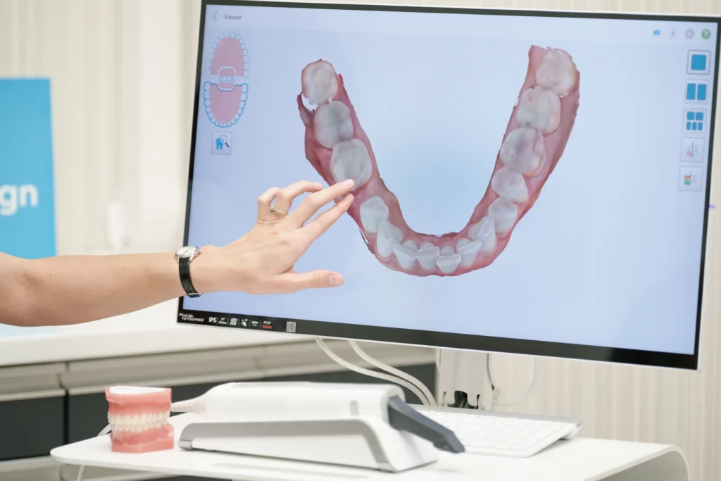 Invisalign® Lite – szybka i delikatna korekta zgryzu