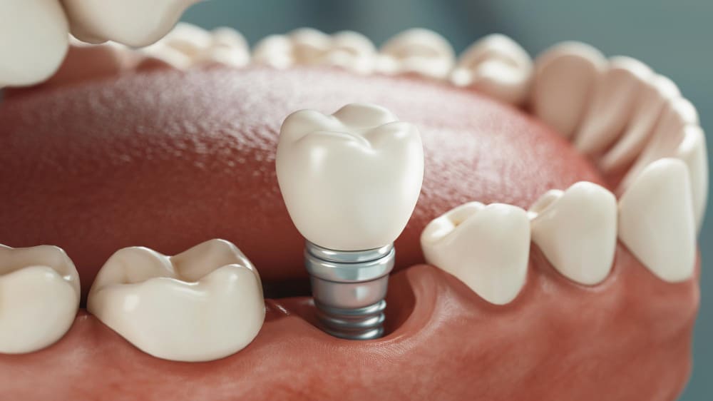 Implant zębowy