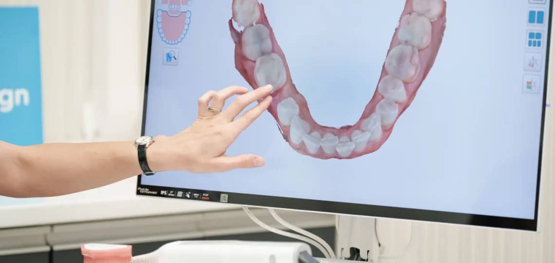 Invisalign Lite