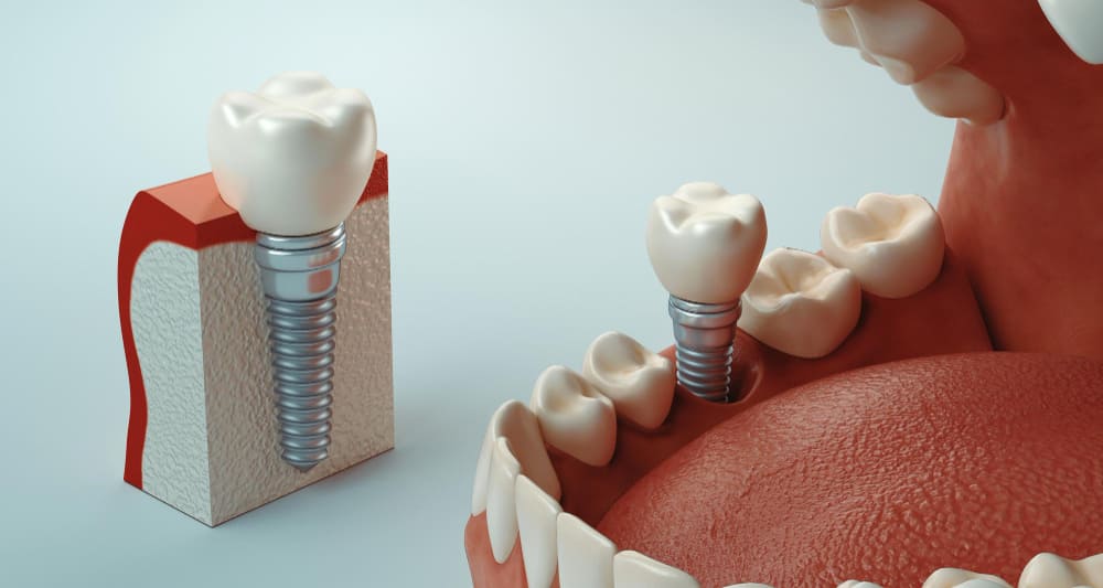 Implant zębowy zdjęcie