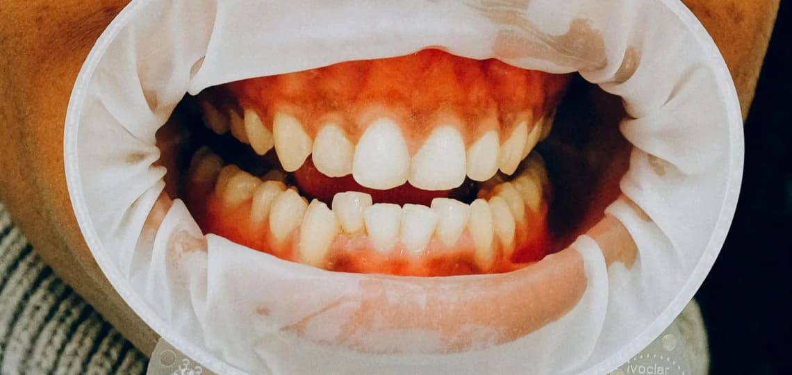 Krzywe zęby na modelu dentystycznym